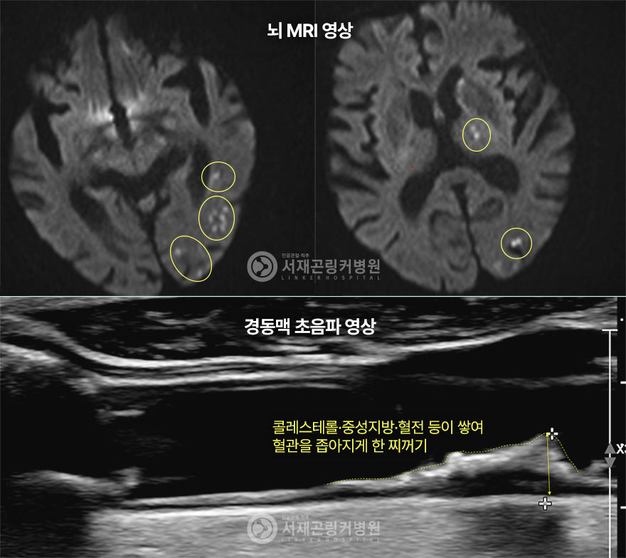 뇌 MRI 영상 | 경동맥 초음파 영상 - 콜레스테롤·중성지방·혈전 등이 쌓여 혈관을 좁아지게 한 찌꺼기