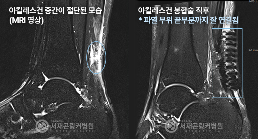 아킬레스건 중간이 절단된 모습(MRI 영상) | 아킬레스건 봉합술 직후 * 파열 부위 끝부분까지 잘 연결됨