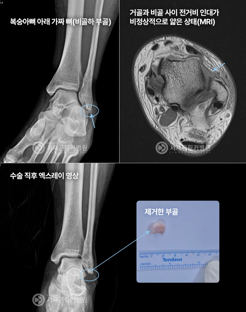 복숭아뼈 아래 가짜 뼈(비골하 부골) | 거골과 비골 사이 전거비 인대가 비정상적으로 얇은 상태(MRI) | 수술 직후 엑스레이 영상(제거한 부골)