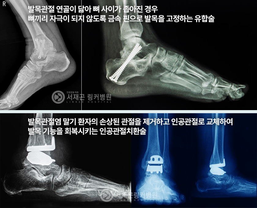 발목관절 연골이 닳아 뼈 사이가 좁아진 경우 뼈끼리 자극이 되지 않도록 금속 핀으로 발목을 고정하는 유합술 | 발목관절염 말기 환자의 손상된 관절을 제거하고 인공관절로 교체하여 발목 기능을 회복시키는 인공관절치환술