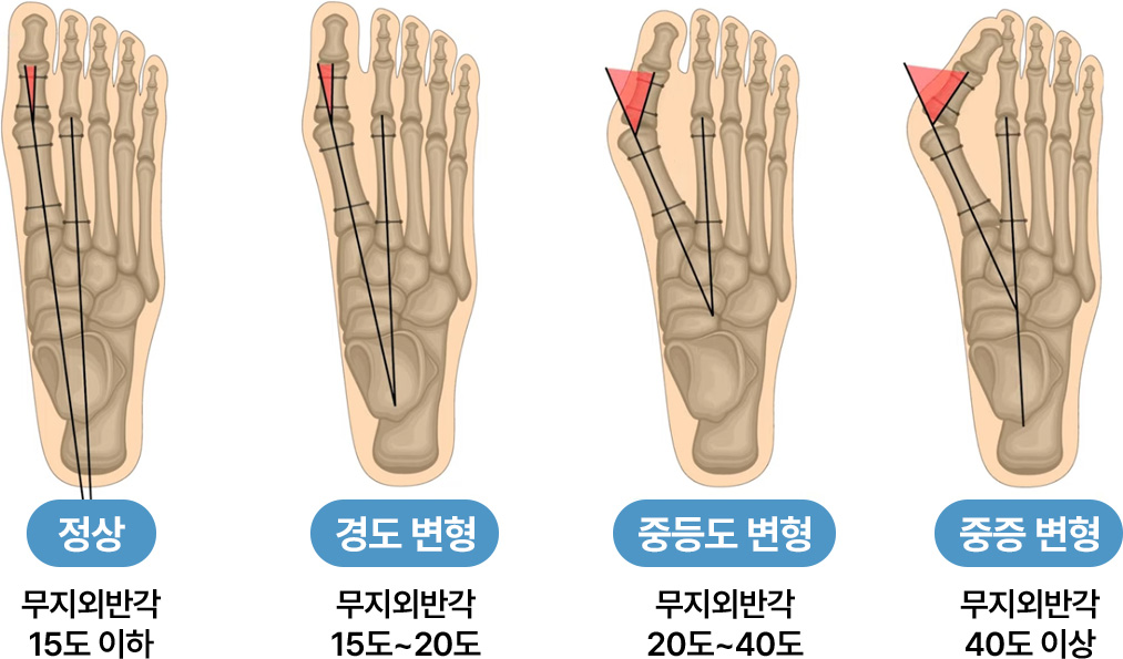 정상 - 무지외반각 15도 이하 | 경도 변형 - 무지외반각 15도~20도 | 중등도 변형 무지외반각 20도~40도 | 중증 변형 - 무지외반각 40도 이상