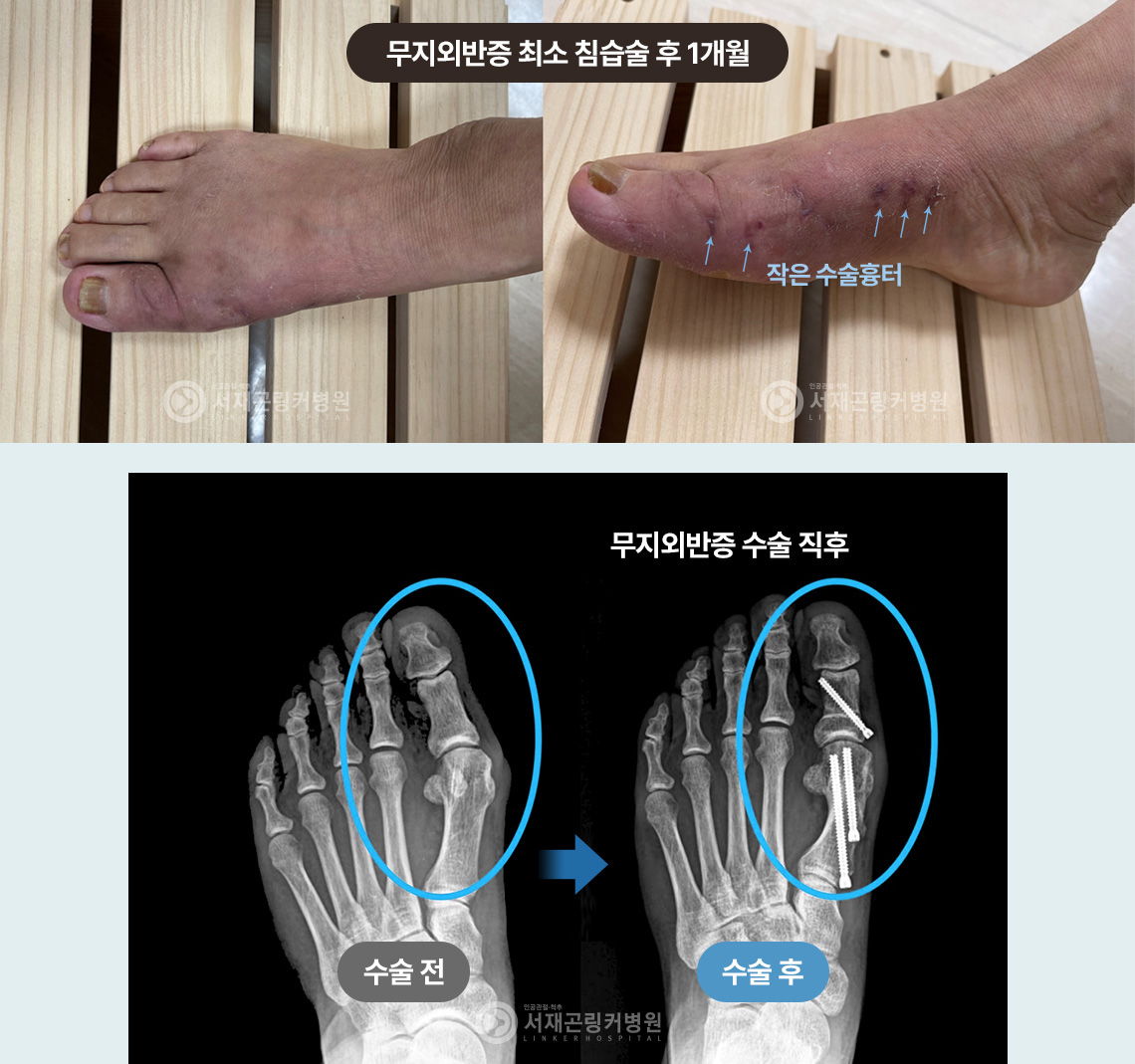 무지외반증 최소 침습술 후 1개월(작은 수술흉터) | 무지외반증 수술 직후