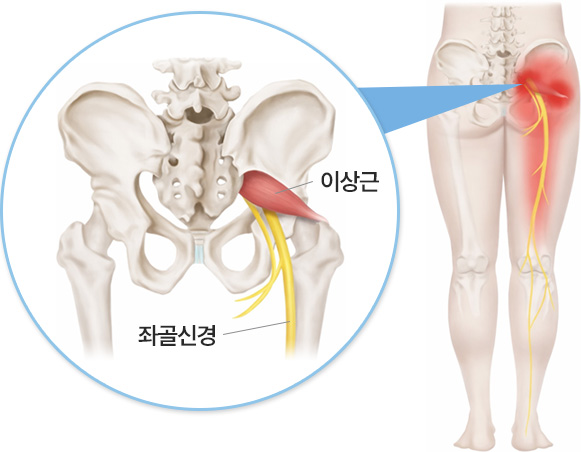 이상근 | 좌골신경
