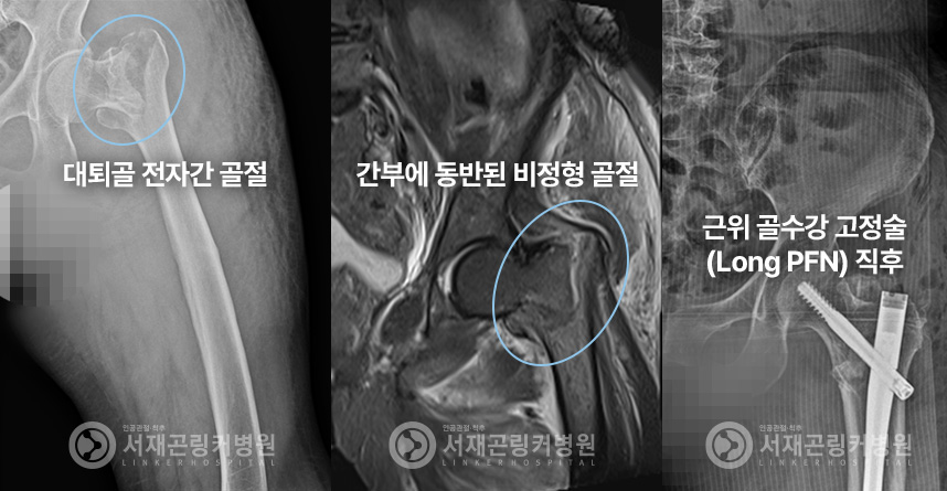 대퇴골 전자간 골절 | 간부에 동반된 비정형 골절 | 근위 골수강 고정술(Long PFN) 직후