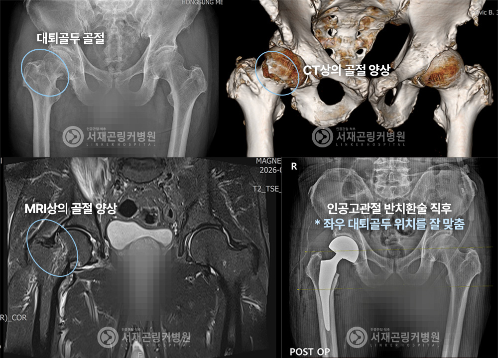 대퇴골두 골절 | CT상의 골절 양상 | MRI상의 골절 양상 | 인공고관절 반치환술 직후 * 좌우 대퇴골두 위치를 잘 맞춤