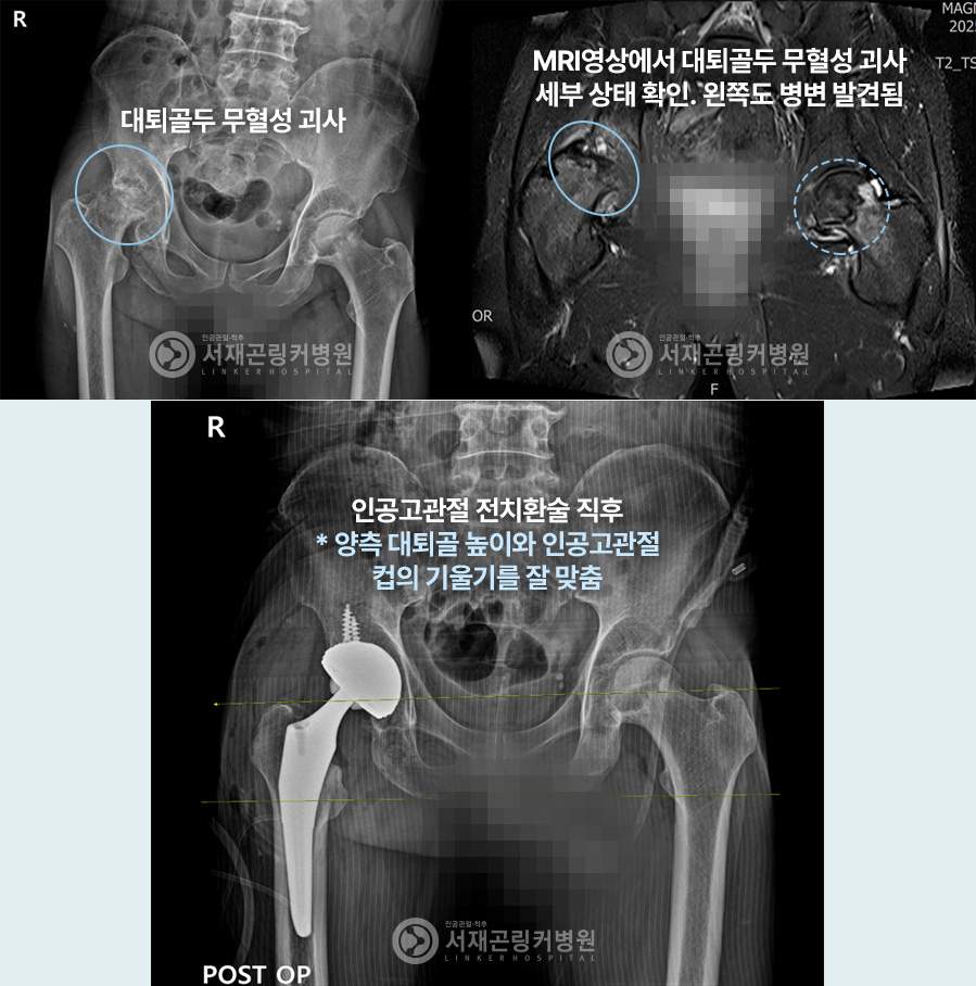 대퇴골두 무혈성 괴사 | MRI영상에서 대퇴골두 무혈성 괴사 세부 상태 확인. 왼쪽도 병변 발견됨 | 인공고관절 전치환술 직후 * 양측 대퇴골 높이와 인공고관절 컵의 기울기를 잘 맞춤