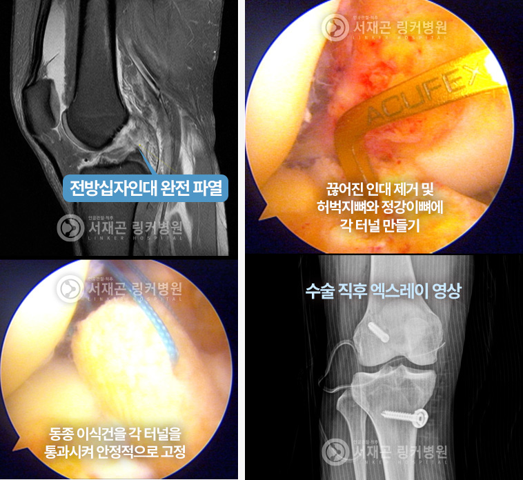 전방십자인대 완전 파열 | 끊어진 인대 제거 및 허벅지뼈와 정강이뼈에 각 터널 만들기 | 동종 이식건을 각 터널을 통과시켜 안정적으로 고정 | 수술 직후 엑스레이 영상