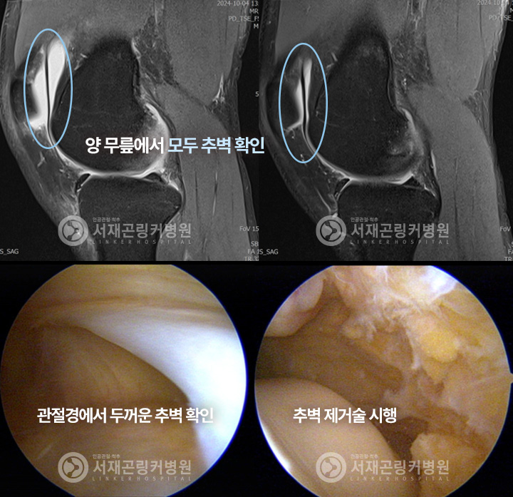 양 무릎에서 모두 추벽 확인 | 관절경에서 두꺼운 추벽 확인 | 추벽 제거술 시행