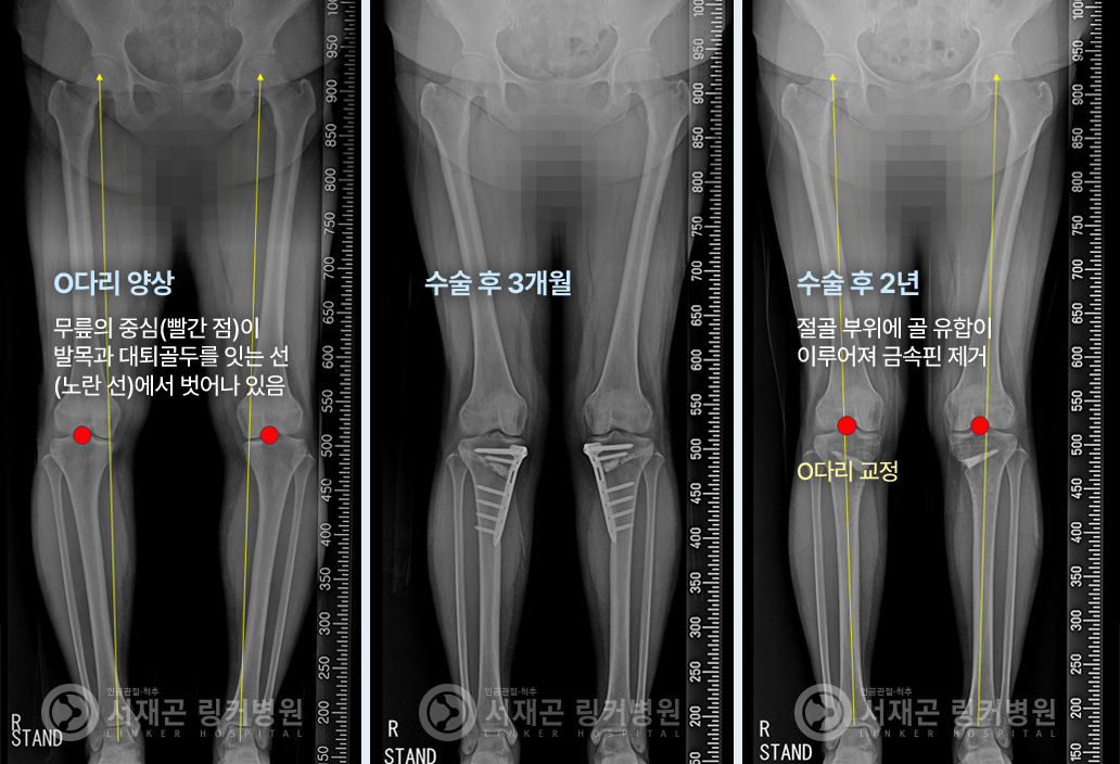 양 무릎에서 모두 추벽 확인 | 관절경에서 두꺼운 추벽 확인 | 추벽 제거술 시행