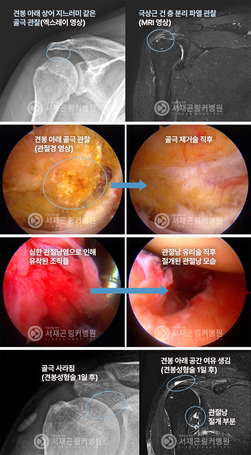 견봉 아래 상어 지느러미 같은 골극 관찰(엑스레이 영상) | 극상근 건 층 분리 파열 관찰(MRI 영상) | 견봉 아래 골극 관찰(관절경 영상) | 골극 제거술 직후 | 심한 관절낭염으로 인해 유착된 조직들 | 관절낭 유리술 직후 절개된 관절낭 모습 | 골극 사라짐(견봉성형술 1일 후) | 견봉 아래 공간 여유 생김(견봉성형술 1일 후) 관절낭 절개 부분
