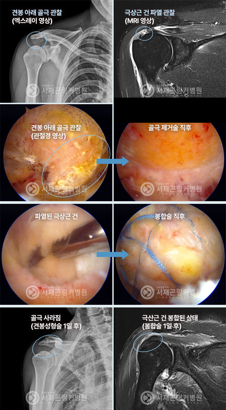 견봉 아래 골극 관찰(엑스레이 영상) | 극상근 건 파열 관찰(MRI 영상) | 견봉 아래 골극 관찰(관절경 영상) | 골극 제거술 직후 | 파열된 극상근 건 | 봉합술 직후 | 골극 사라짐(견봉성형술 1일 후) | 극산근 건 봉합된 상태(봉합술 1일 후)