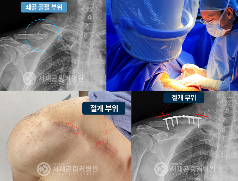쇄골 골절 부위 | 절개 부위 | 절개 부위