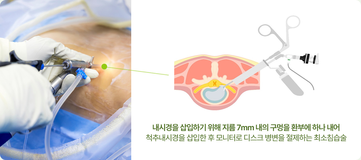 내시경을 삽입하기 위해 지름 7mm 내의 구멍을 환부에 하나 내어 척추내시경을 삽입한 후 모니터로 디스크 병변을 절제하는 최소침습술
