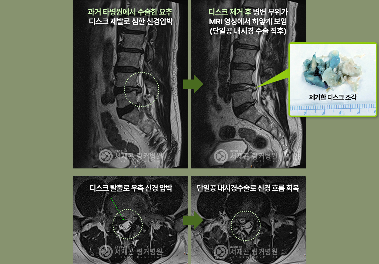 과거 타병원에서 수술한 요추 디스크 재발로 심한 신경압박 > 디스크 제거 후 병변 부위가 MRI 영상에서 하얗게 보임(단일공 내시경 수술 직후) | 디스크 탈출로 우측 신경 압박 > 단일공 내시경수술로 신경 흐름 회복