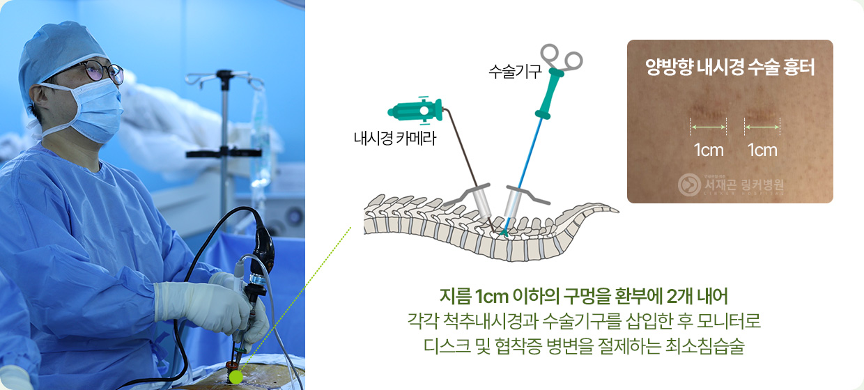 지름 1cm 이하의 구멍을 환부에 2개 내어 각각 척추내시경과 수술기구를 삽입한 후 모니터로 디스크 및 협착증 병변을 절제하는 최소침습술