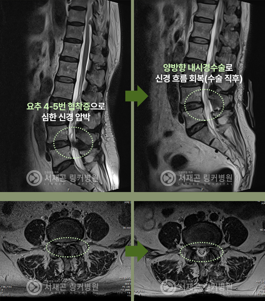 요추 4-5번 협착증으로 심한 신경 압박 > 양방향 내시경수술로 신경 흐름 회복(수술 직후)