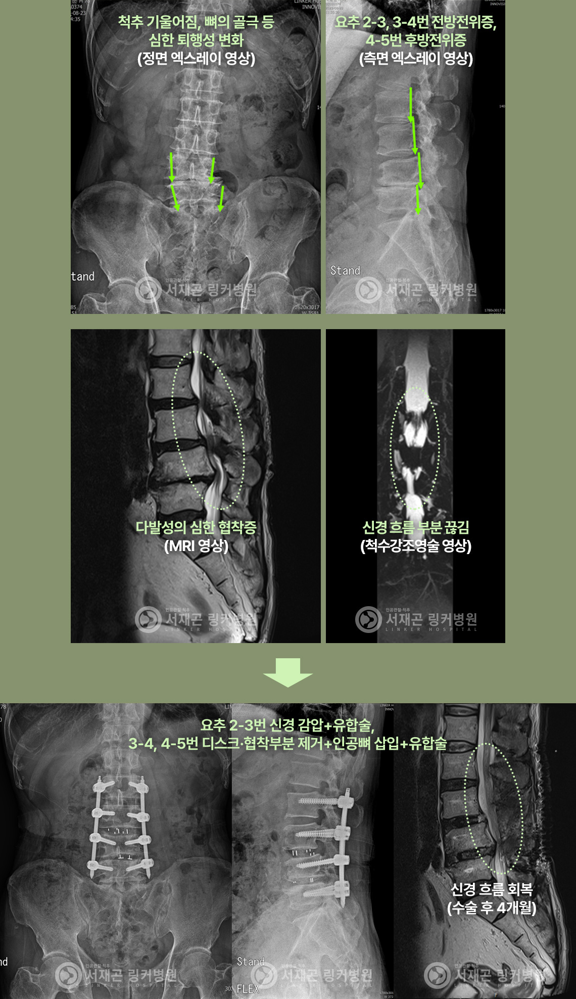 척추 기울어짐, 뼈의 골극 등 심한 퇴행성 변화(정면 엑스레이 영상) | 요추 2-3, 3-4번 전방전위증, 4-5번 후방전위증(측면 엑스레이 영상) | 다발성의 심한 협착증(MRI 영상) | 신경 흐름 부분 끊김(척수강조영술 영상) | 요추 2-3번 신경 감압+유합술, 3-4, 4-5번 디스크·협착부분 제거+인공뼈 삽입+유합술(신경 흐름 회복(수술 후 4개월))