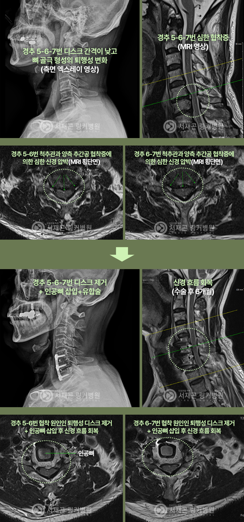 경추 5-6-7번 디스크 간격이 낮고 뼈 골극 형성의 퇴행성 변화(측면 엑스레이 영상) | 경추 5-6-7번 심한 협착증(MRI 영상) | 경추 5-6번 척추관과 양측 추간공 협착증에 의한 심한 신경 압박(MRI 횡단면) | 경추 6-7번 척추관과 양측 추간공 협착증에 의한 심한 신경 압박(MRI 횡단면) | 경추 5-6-7번 디스크 제거 + 인공뼈 삽입+유합술 | 신경 흐름 회복(수술 후 6개월) | 경추 5-6번 협착 원인인 퇴행성 디스크 제거 + 인공뼈 삽입 후 신경 흐름 회복 | 경추 6-7번 협착 원인인 퇴행성 디스크 제거 + 인공뼈 삽입 후 신경 흐름 회복