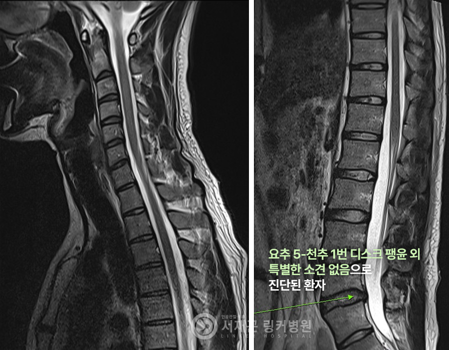 요추 5-천추 1번 디스크 팽윤 외 특별한 소견 없음으로 진단된 환자