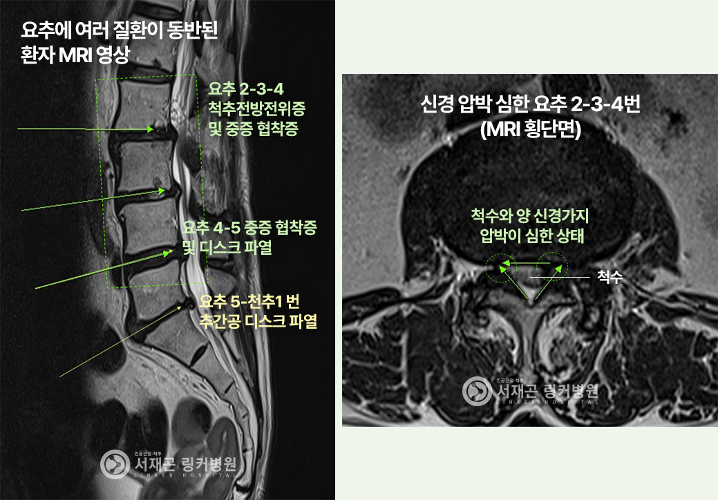 요추에 여러 질환이 동반된 환자 MRI 영상 : 요추 2-3-4 척추전방전위증 및 중증 협착증, 요추 4-5 중증 협착증 및 디스크 파열, 요추 5-천추1 번 추간공 디스크 파열 | 신경 압박 심한 요추 2-3-4번(MRI 횡단면) : 척수와 양 신경가지 압박이 심한 상태