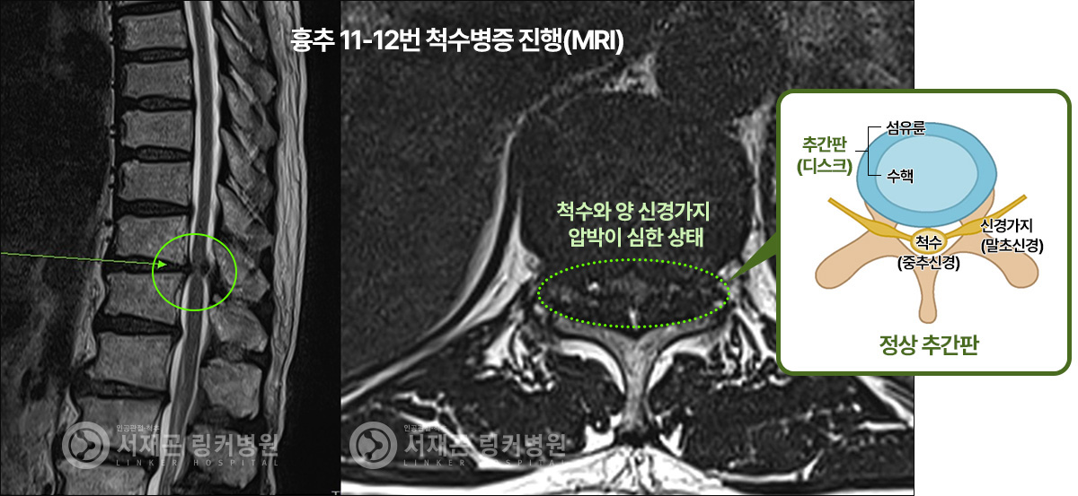 흉추 11-12번 척수병증 진행(MRI) : 척수와 양 신경가지 압박이 심한 상태