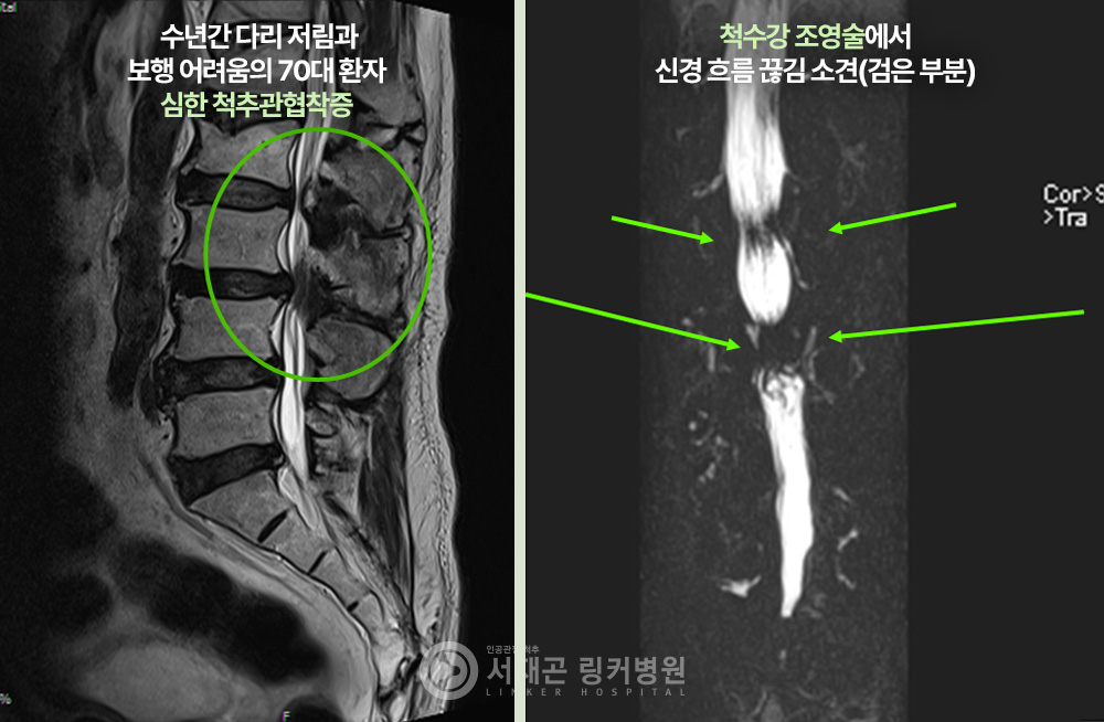 수년간 다리 저림과 보행 어려움의 70대 환자 심한 척추관협착증 | 척수강 조영술에서 신경 흐름 끊김 소견(검은 부분)