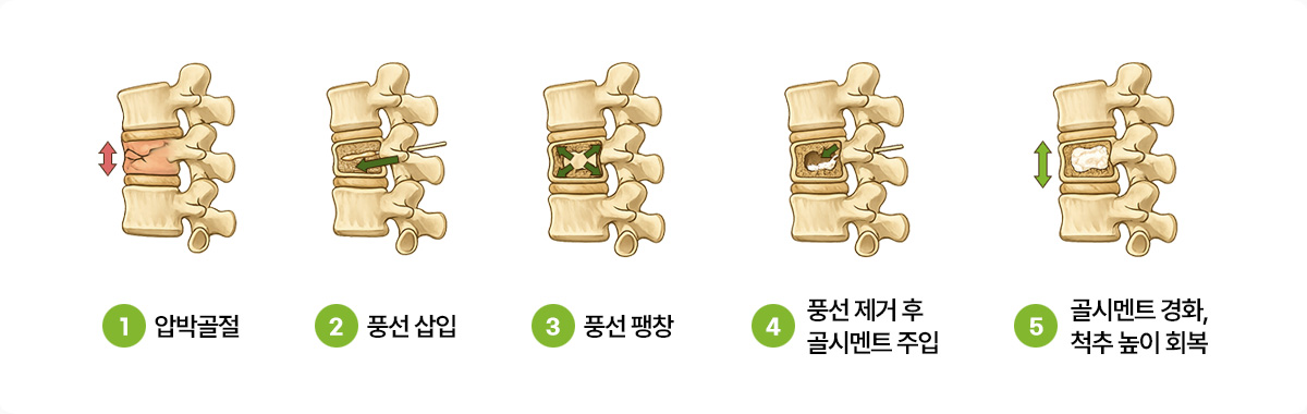 1.압박골절 2.풍선 삽입 3.풍선 팽창 4.풍선 제거 후 골시멘트 주입 5.골시멘트 경화, 척추 높이 회복