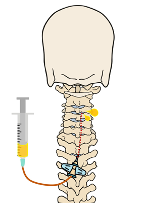 디스크 신경성형술 효과 및 비용 분석